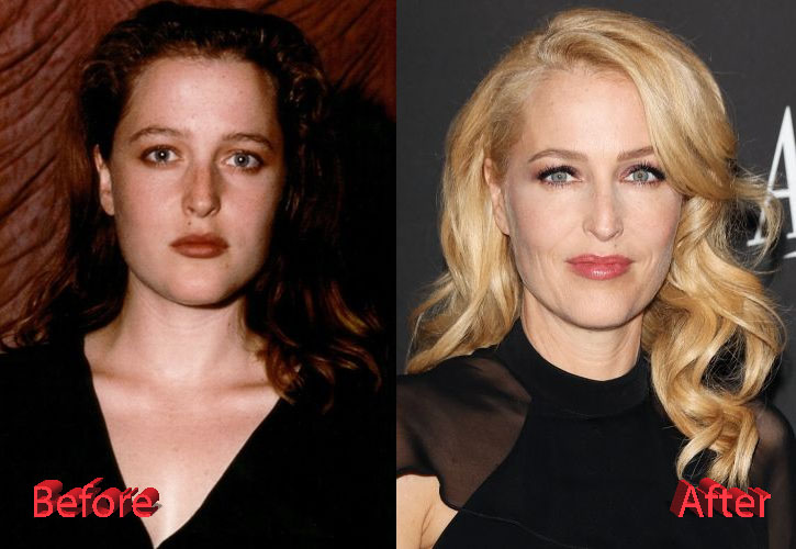Gillian Anderson Plastic Surgery Before and After2