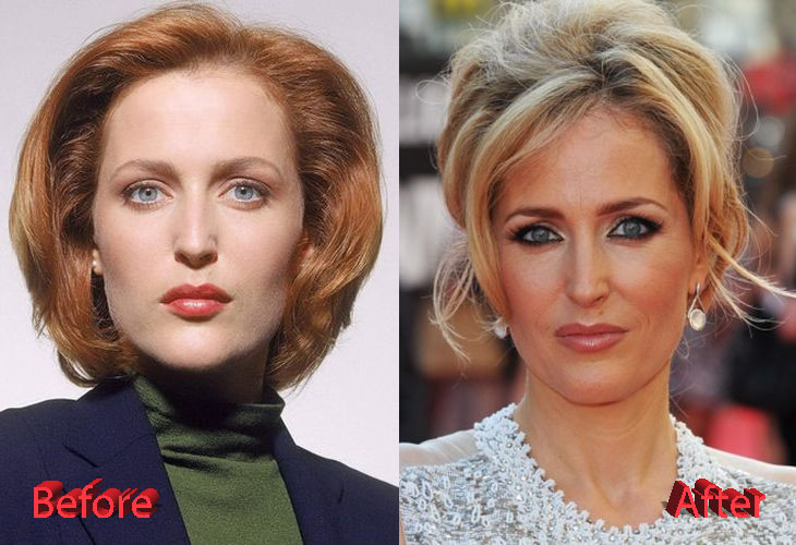 Gillian Anderson Plastic Surgery Before and After3