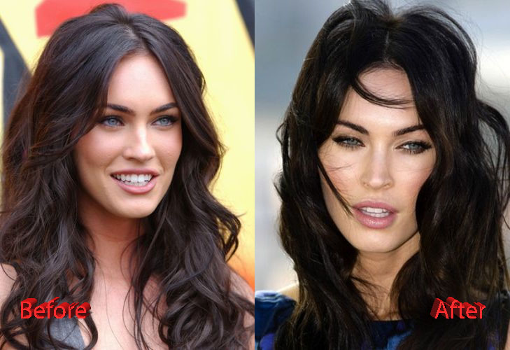 Megan Fox Plastic Surgery Before and After3