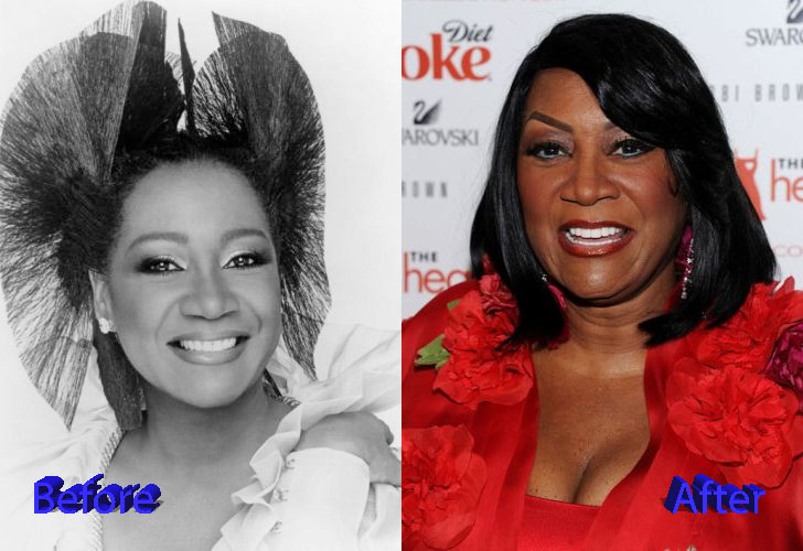 Patti Labelle Before and After Surgery Photo