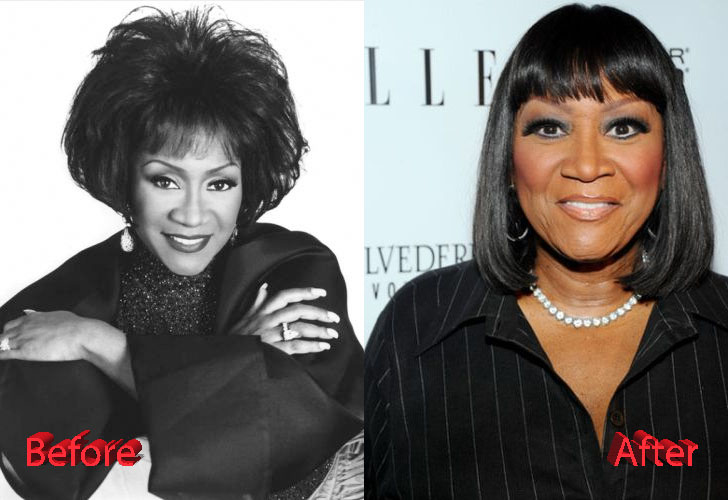 Patti Labelle Plastic Surgery Before and After