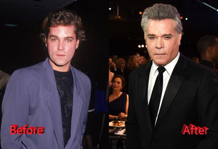 Ray Liotta Before and After Cosmetic Surgery
