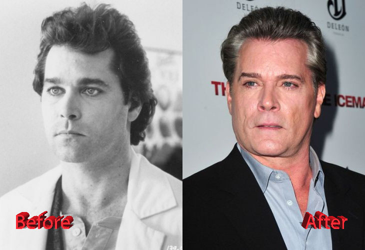 Ray Liotta Cosmetic Procedure Before and After