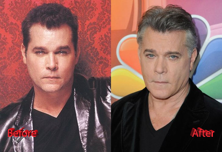 Ray Liotta Plastic Surgery Before and After
