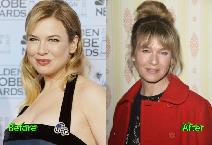 Renee Zellweger Before and After Cosmetic Surgery