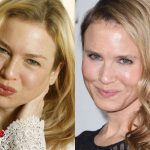 Renee Zellweger Before and After Surgery
