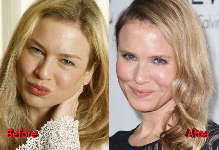Image result for Renee Zellweger before and after