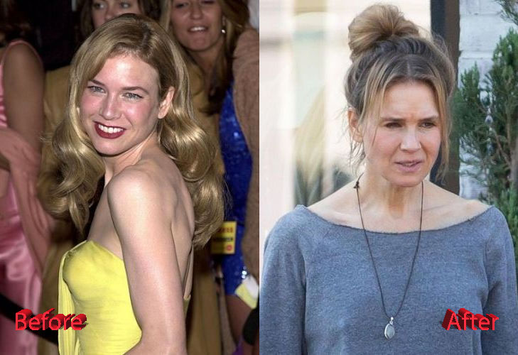 Renee Zellweger Plastic Surgery Before and After