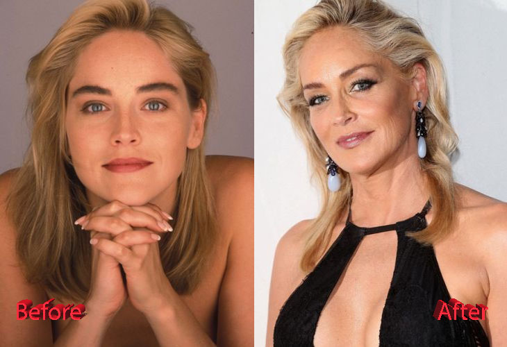 Sharon Stone Before and After Cosmetic Surgery