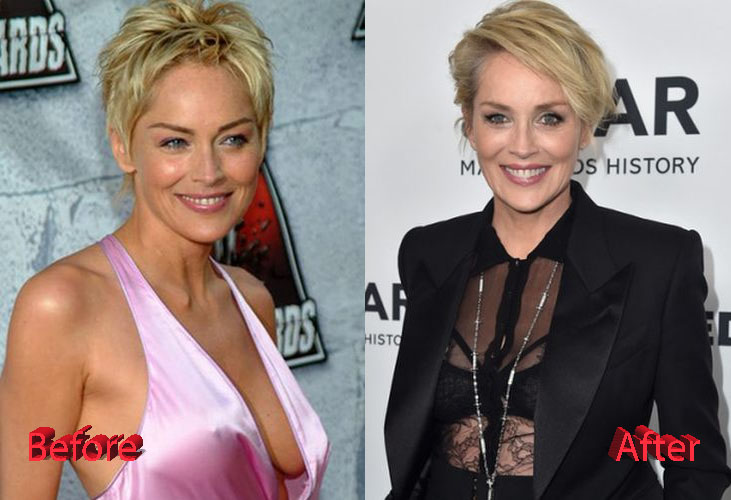 Sharon Stone Before and After Surgery Photo
