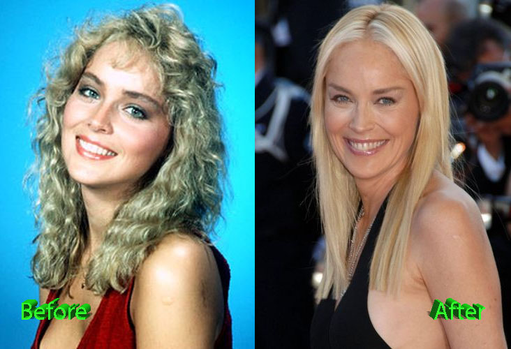 Sharon Stone Plastic Surgery Before and After