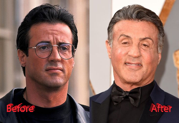 Sylvester Stallone Before and After Cosmetic Procedure