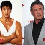 Sylvester Stallone Before and After Surgery 150x150