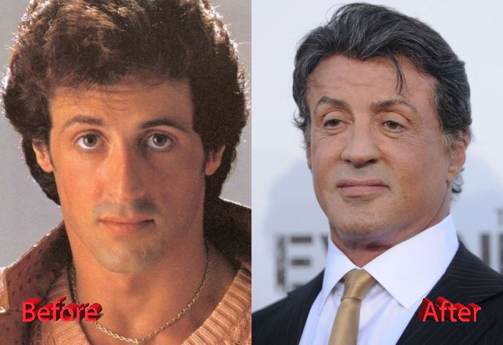 Sylvester Stallone Plastic Surgery A New Rocky? Plastic