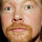 Axl Rose After Plastic Surgery 2016