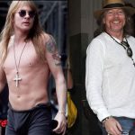 Axl Rose Before and After Cosmetic Surgery