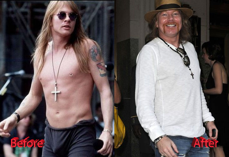 Axl Rose Before and After Cosmetic Surgery