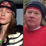 Axl Rose Plastic Surgery Before and After