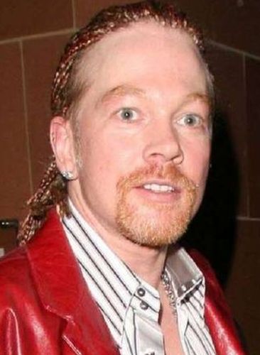 Axl Rose Plastic Surgery: A Bad Decision