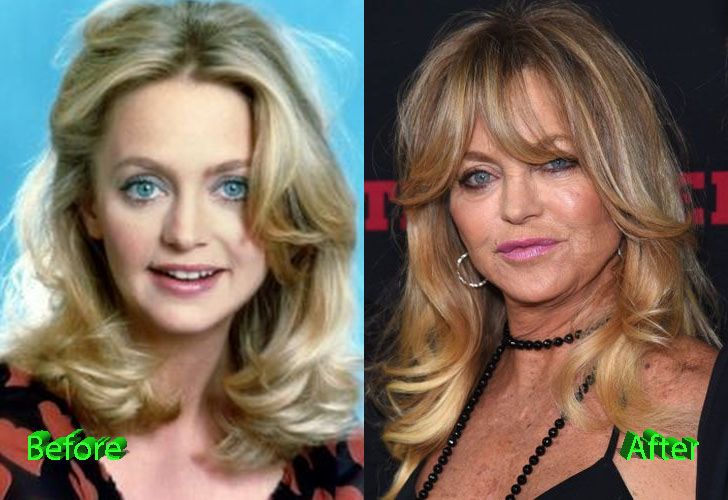 Goldie Hawn Before and After Cosmetic Surgery