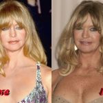 Goldie Hawn Before and After Facelift 150x150