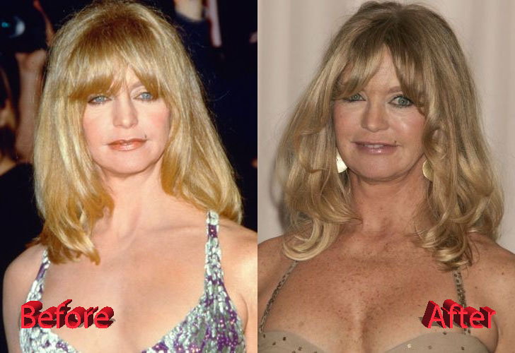 Goldie Hawn Before and After Facelift