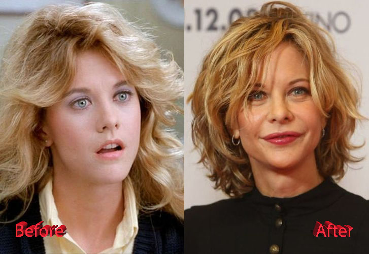 Meg Ryan Before and After Cosmetic Surgery