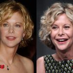 Meg Ryan Before and After Facelift