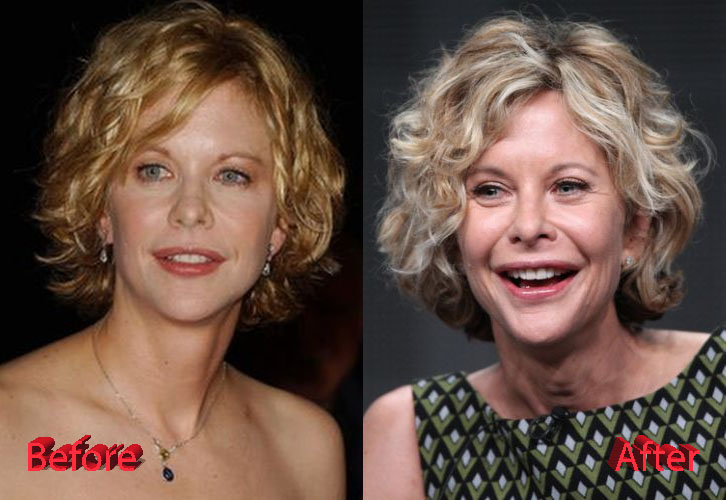 Meg Ryan Before and After Facelift