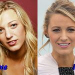 Blake Lively Before and After Nose Job Surgery 150x150