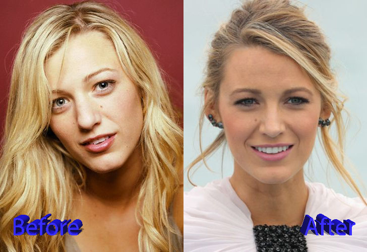 Blake Lively Before and After Nose Job Surgery