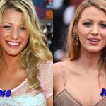Blake Lively Nose Job Before and After 150x150