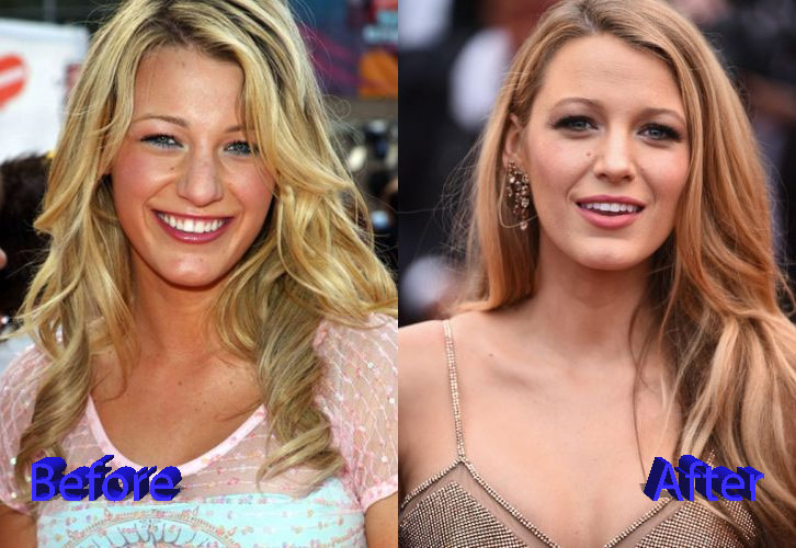 Blake Lively Nose Job Before and After