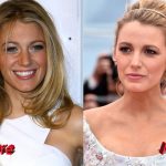 Blake Lively Plastic Surgery Before and After 150x150