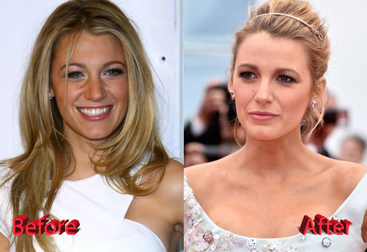 Blake Lively Plastic Surgery Before and After