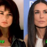Demi Moore Before and After Cosmetic Surgery 150x150