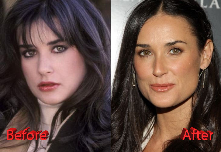 Demi Moore Plastic Surgery Before and After