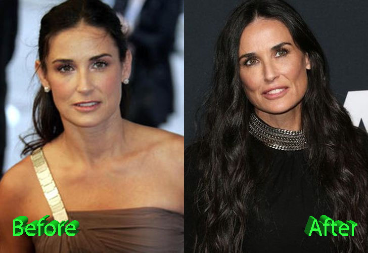 Demi Moore Surgery Transformation Before and After