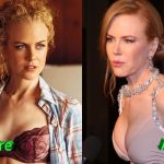 Nicole Kidman Before and After Boob Job 150x150