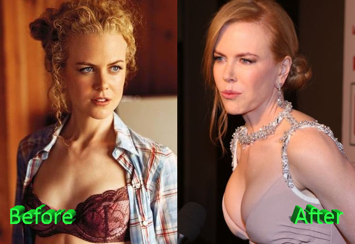 Nicole Kidman Before and After Boob Job. 