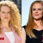 Nicole Kidman Before and After Cosmetic Surgery 150x150
