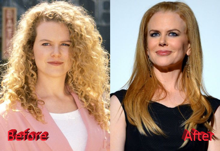 Nicole Kidman Before and After Cosmetic Surgery