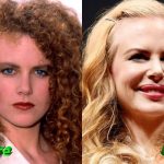 Nicole Kidman Plastic Surgery Before and After 150x150