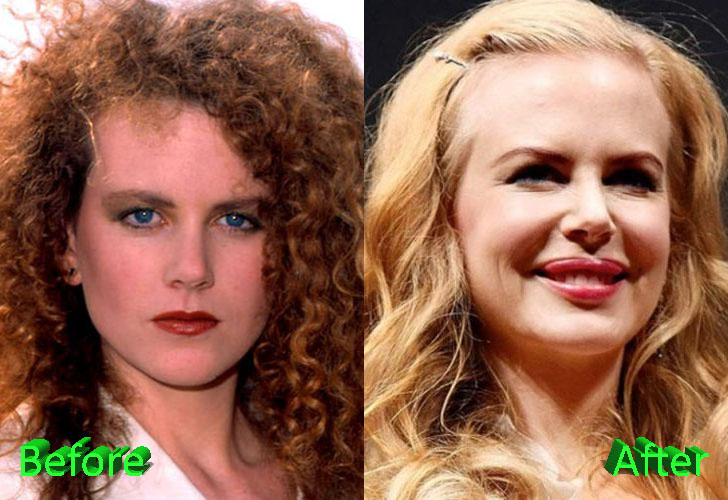 Nicole Kidman Plastic Surgery Before and After