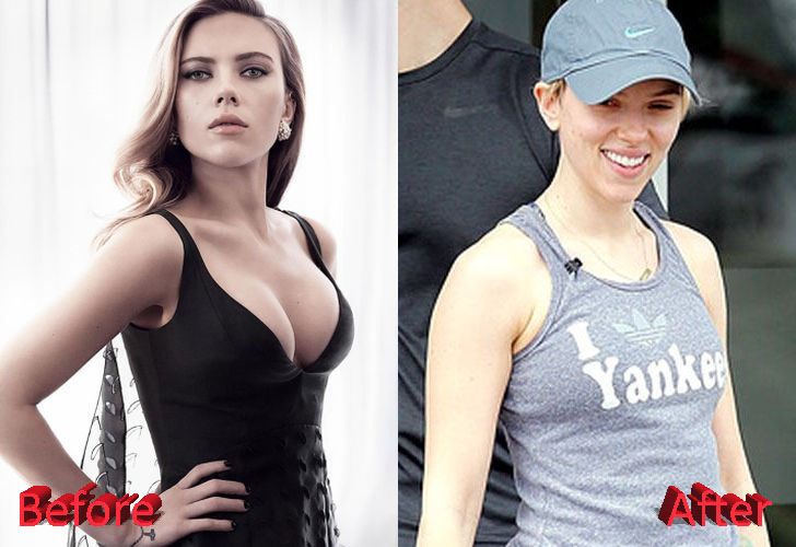 Scarlett Johansson Before and After Breast Reduction