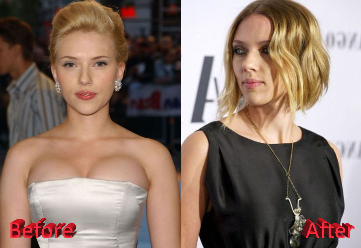 Scarlett Johansson Breast Reduction Before and After