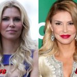 Brandi Glanville Before and After Botox Procedure 150x150