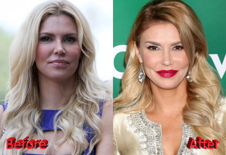 Brandi Glanville Before and After Botox Procedure