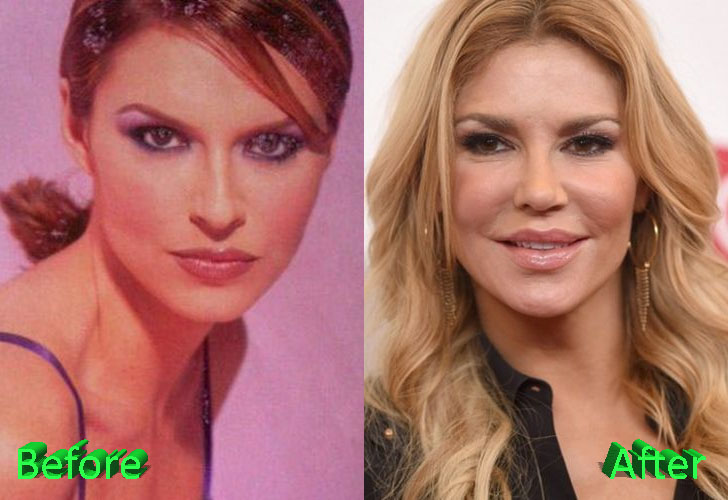 Brandi Glanville Before and After Cosmetic Surgery