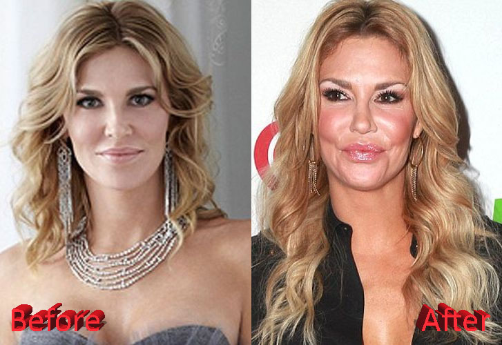 Brandi Glanville Plastic Surgery Before and After